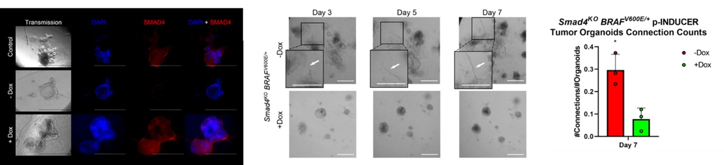 Image of SMAD4/TGFβ in CRC