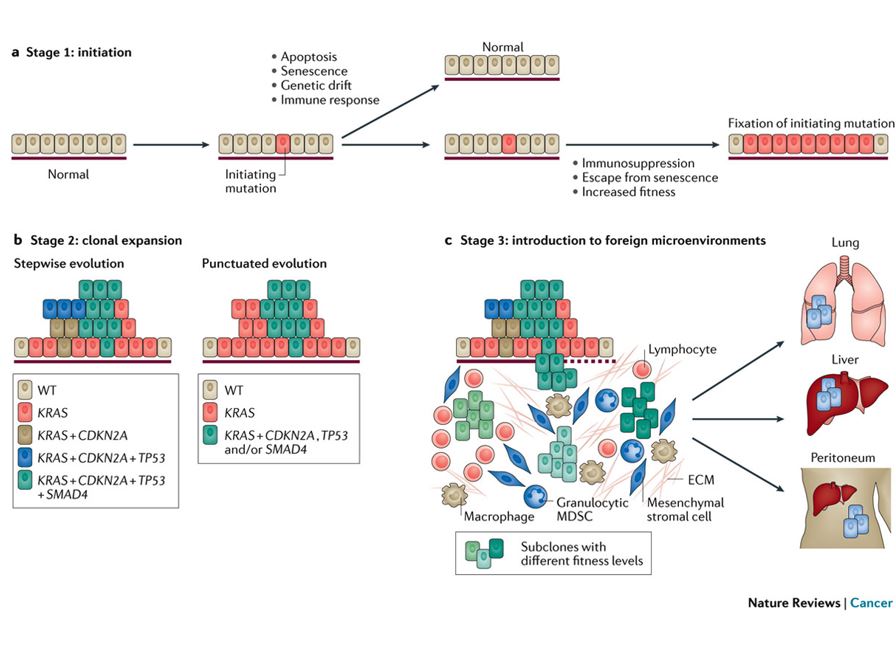 Stages of pancreatic cancer evolution